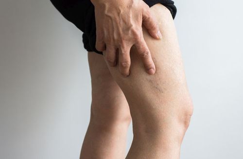 Żylaki nóg – przyczyny, leczenie, domowe sposoby