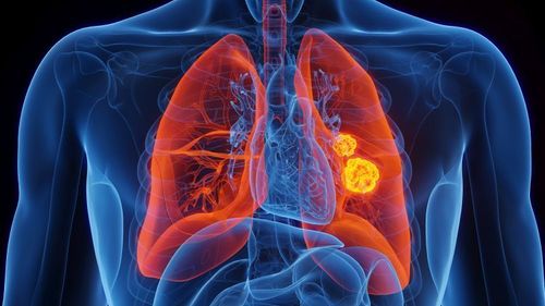 Rak płuc – objawy, przyczyny, profilaktyka i leczenie